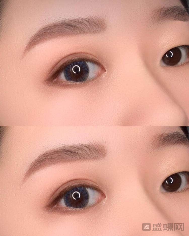 做双眼皮手术前你需要了解些什么？