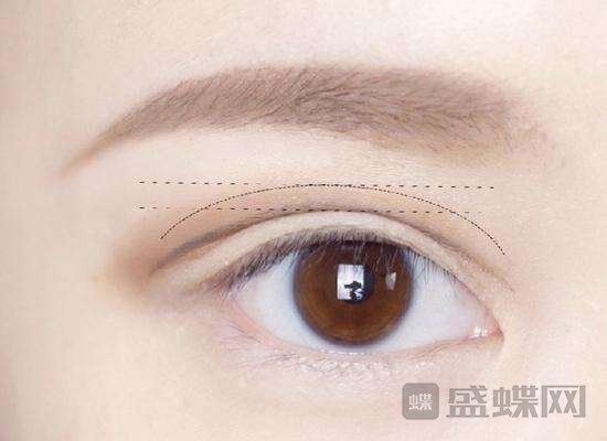 哪些人适合做双眼皮手术？