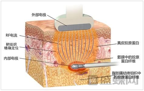 做射频瘦身减肥的价格是多少？