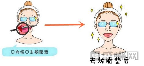 颊脂垫取出手术有哪些方法？