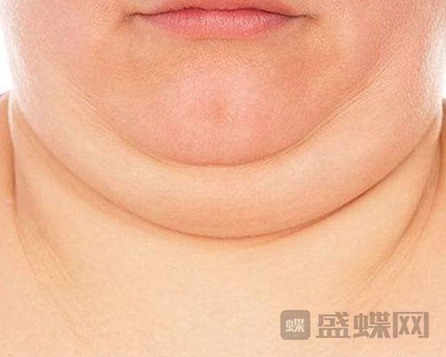 如何消除双下巴？下巴吸脂要注意的三件事。