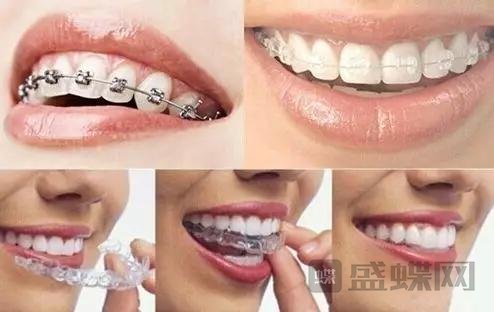 如何矫正牙齿？牙齿正畸是什么？