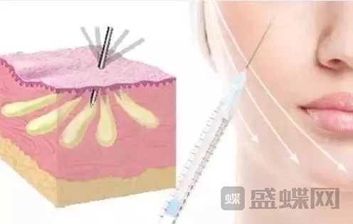 面部自体脂肪填充有哪些问题？