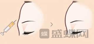 玻尿酸丰额头需要几支?