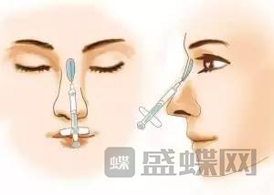 玻尿酸隆鼻图片对比，手术科普