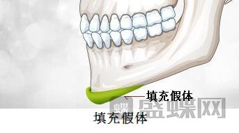 假体隆下巴术后多久时间才达到整形效果