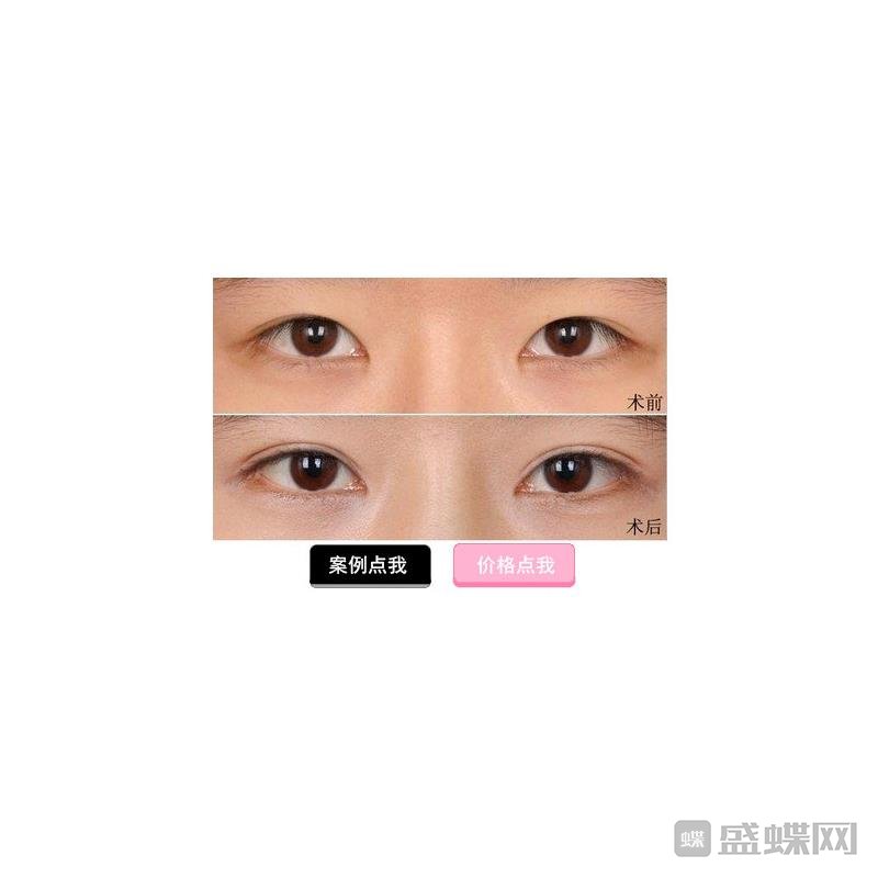 双眼皮修复为什么比双眼皮手术难？