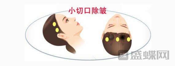 小切口除皱方法怎么样？