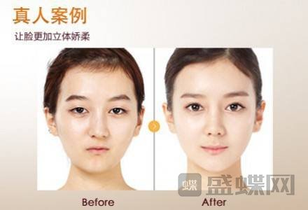 做完自体脂肪丰太阳穴后皮肤有弹性吗？