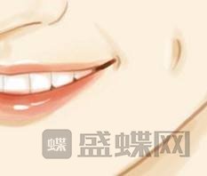 人造酒窝术后会影响面部表情自然吗