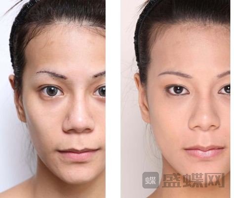 做自体脂肪丰太阳穴手术需要多长时间？