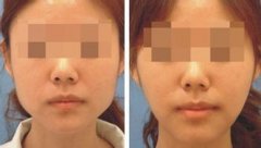 北京美玉颜下颌角整形手术效果怎么