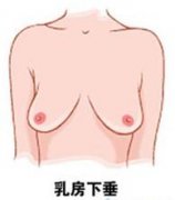 上海九院胸部下垂矫正手术费用贵不贵？