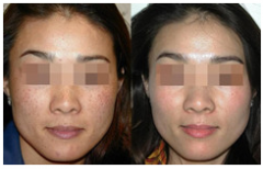 <b>北京鹏爱医疗美容医院黄褐斑治疗方法</b>