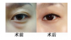 <b>长沙鹏爱医疗美容医院去眼袋手术的费用是多少</b> <b>长沙鹏爱医疗美容医院去眼袋手术的费用是多少</b>
