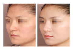 郑州集美美容医院假体隆鼻多少钱? 郑州集美美容医院假体隆鼻多少钱?