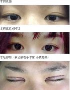 上海九院黄如林医生做的全切双眼皮开内眼角效