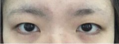 隋医生做的全切双眼皮手术