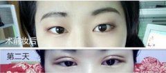 合肥华美朱主任做的全切双眼皮手术效果