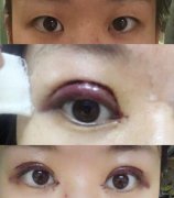 杭州117医院陆新医生做的双眼皮效果