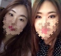 西安西京医院刘超华医生做的双眼皮开眼角