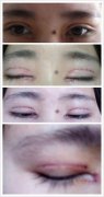 洛阳华美医疗美容医院宋俊岭做的双眼皮效果