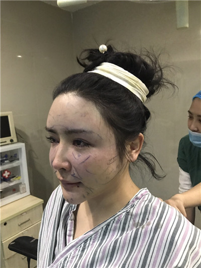 重庆铂生,杜亚旭,面部填充案例,价格,分享,