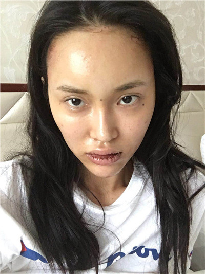 北京百达丽,苏婷,厚唇改薄,案例,价格,