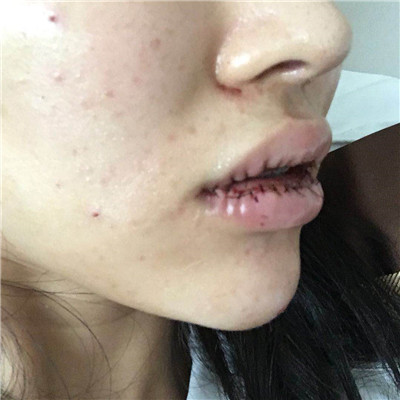 北京百达丽,苏婷,厚唇改薄,案例,价格,