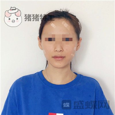 哈尔滨美联致美,侯锋玉,面部填充,案例,价格,