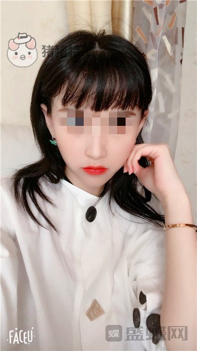 哈尔滨美联致美,侯锋玉,面部填充,案例,价格,