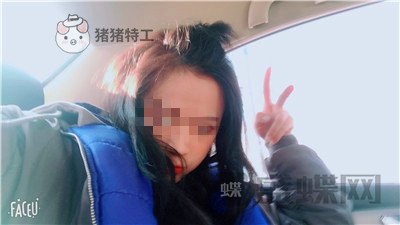 哈尔滨美联致美,侯锋玉,面部填充,案例,价格,