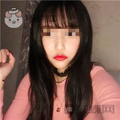 哈尔滨美联致美,侯锋玉,面部填充,案例,价格,