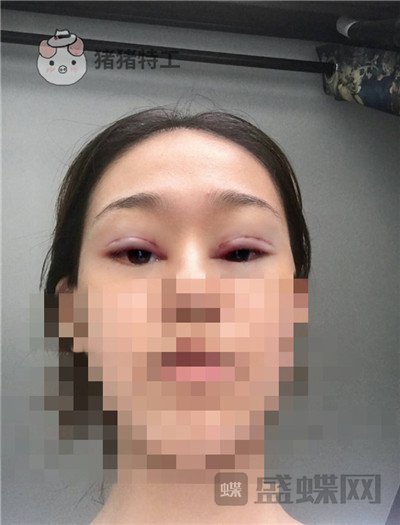 杭州美莱,韩超,双眼皮,案例,价格,