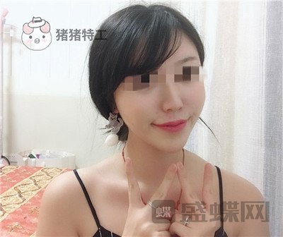 北京润美玉之光,王明利,面部填充,案例,价格,