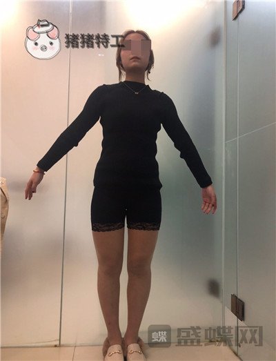 昆明梦想整形,李成龙,吸脂,案例,价格,