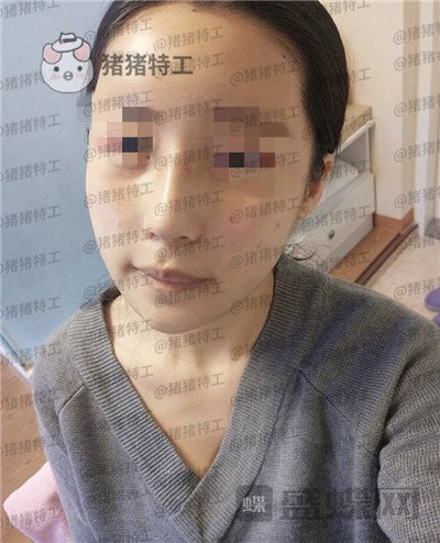 上海九院,张盈帆,隆鼻,案例,价格,