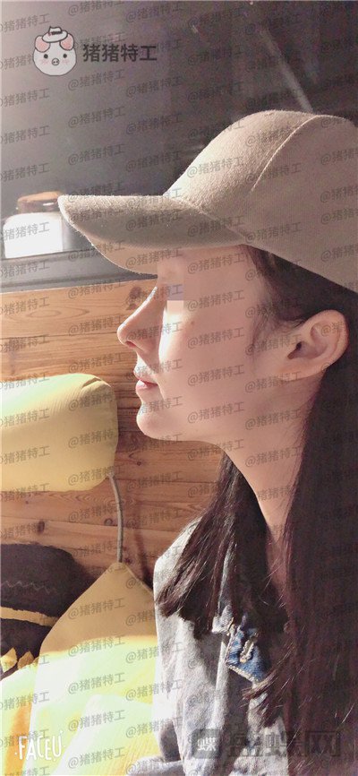 成都西区医院,车红昌,隆鼻,案例,价格,