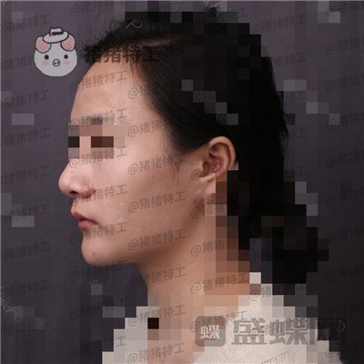 上海华美,李志海,下颌角整形,案例,价格,