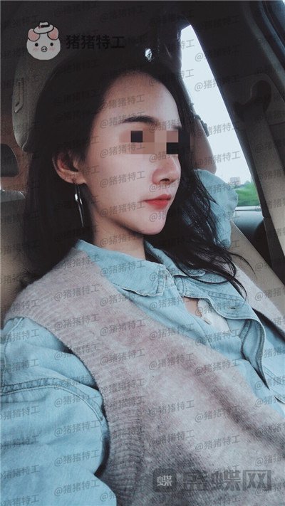 上海华美,李志海,下颌角整形,案例,价格,