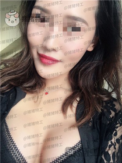 郑州集美,赵亮,隆胸,案例,价格,
