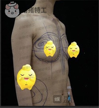 北京,京韩,王沛森,隆胸,案例,价格,