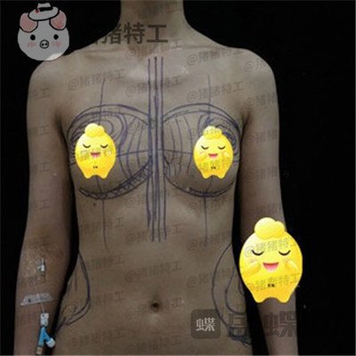北京,京韩,王沛森,隆胸,案例,价格,