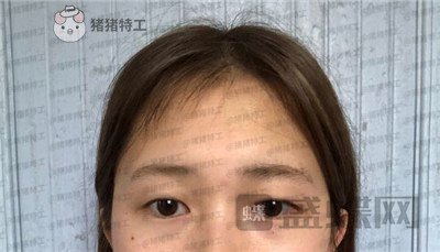 广东画美,牟北平,双眼皮,案例,价格,