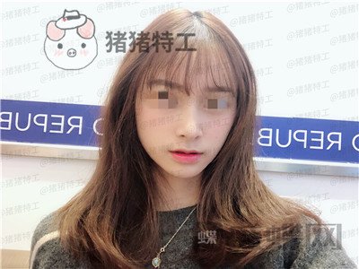 重庆铂生,杜亚旭,隆鼻,案例,价格,