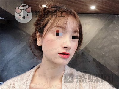 重庆铂生,杜亚旭,隆鼻,案例,价格,