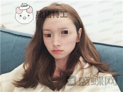 重庆铂生,杜亚旭,隆鼻,案例,价格,
