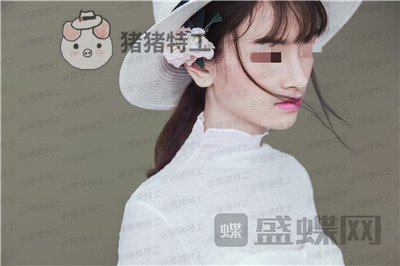重庆铂生,杜亚旭,隆鼻,案例,价格,