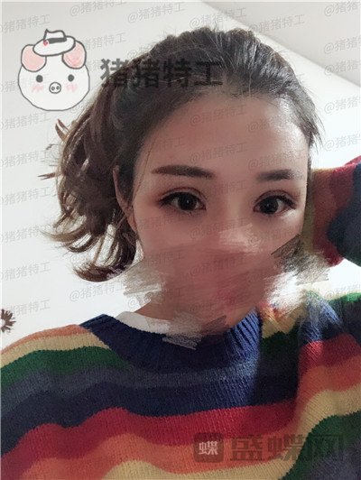 成都西区医院，车红昌，双眼皮，案例，价格，