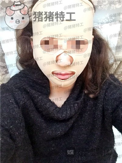 重庆华美,潘宝华,颧骨整形,案例,价格,